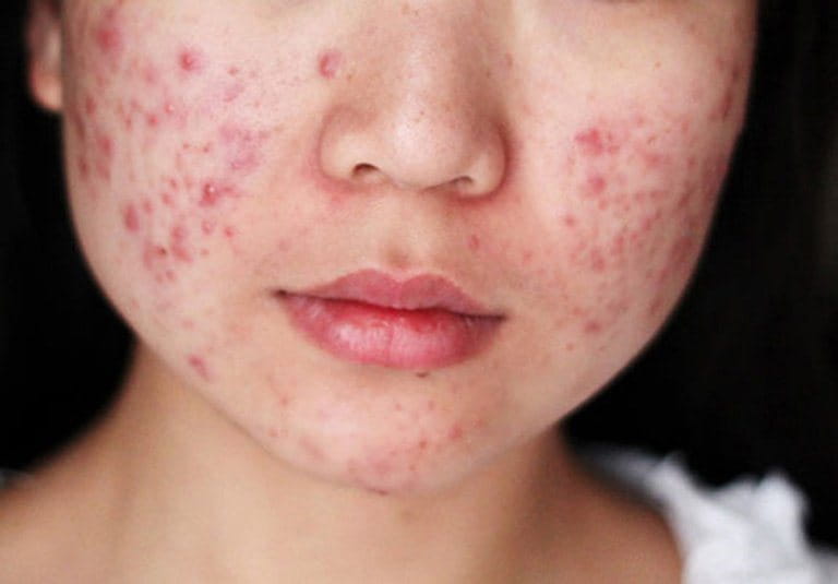 cách trị mụn hiệu quả