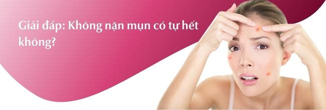 Giải đáp không nặn mụn có tự hết không