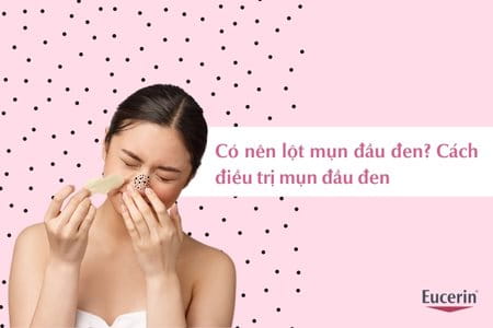Có nên lột mụn đầu đen hay không?