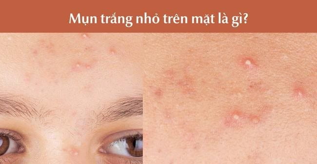 Mụn đầu trắng là gì?