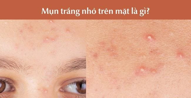 Mụn đầu trắng là gì? 