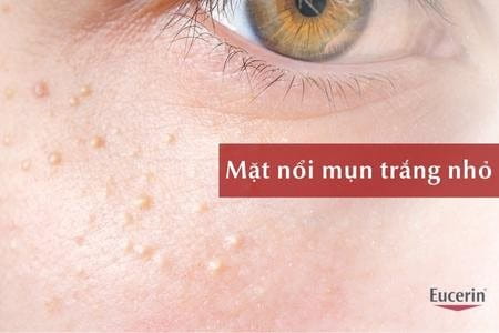 Mặt nổi mụn trắng nhỏ li ti