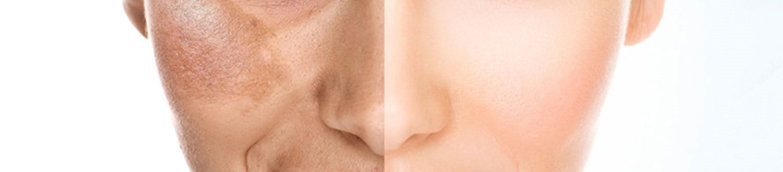 review kem trị nám hiệu quả