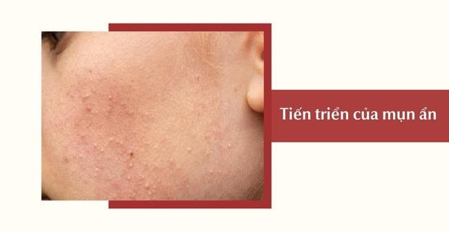 Quá trình tiến triển của mụn ẩn