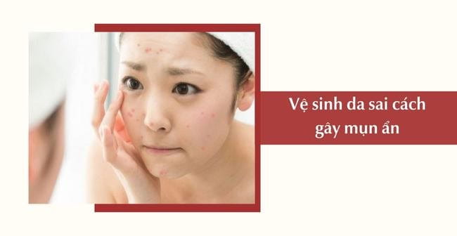 Vệ sinh da sai cách gây mụn