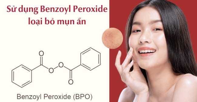 Trị mụn ẩn với Benzoyl Peroxide