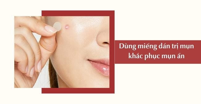 Dùng miếng dán trị mụn khắc phục mụn ẩn