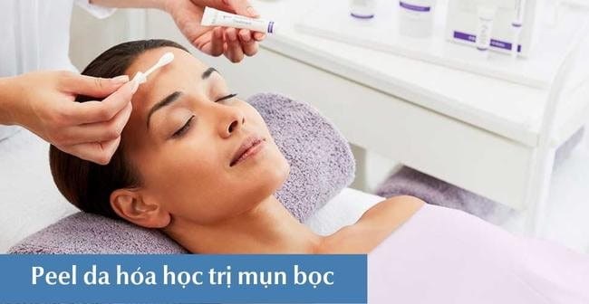 Peel da trị mụn bọc