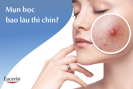 Mụn bọc bao lâu thì chín? Cách trị mụn bọc hiệu quả