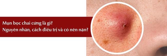 Mụn bọc chai cứng là gì nguyên nhân cách điều trị có nên nặn không