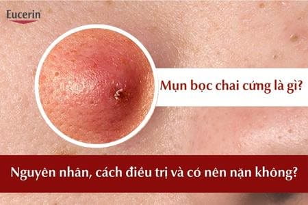 Nguyên nhân cách điều trị mụn bọc chai cứng có nên nặn không