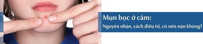 Mụn bọc ở cằm: Nguyên nhân, cách điều trị, có nên nặn không?