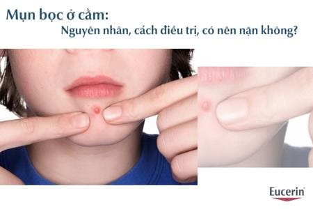 Mụn bọc ở cằm có nên nặn không? Nguyên nhân và cách điều trị