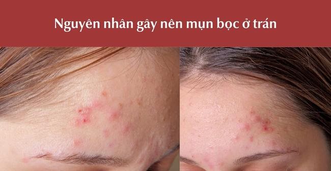 nguyên nhân gây nên mụn bọc ở trán