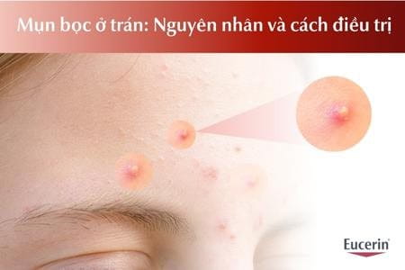 mụn bọc ở trán nguyên nhân và cách điều trị