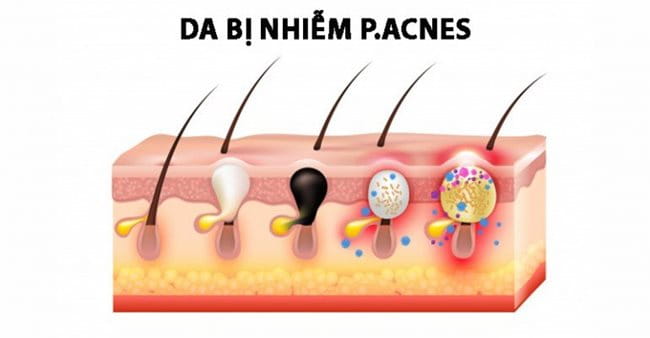 Da bị nhiễm vi khuẩn P.Acnes thuộc trong các nguyên nhân chính gây mụn bọc