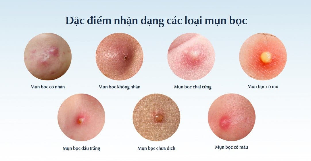 Đặc điểm nhận dạng các loại mụn bọc