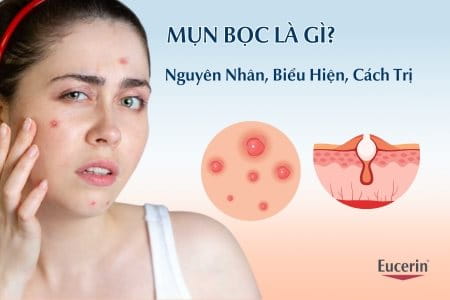 mụn bọc