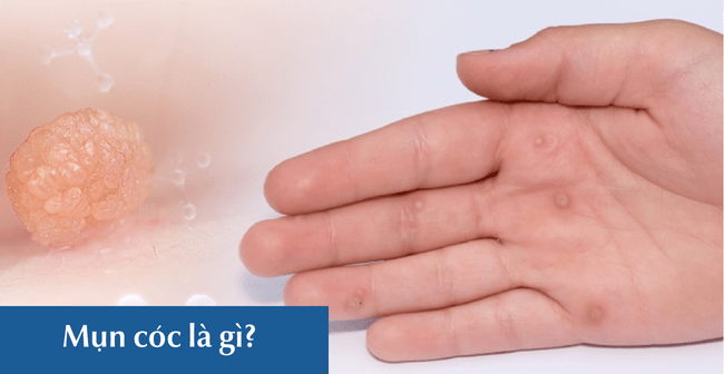 Mụn cóc là gì?