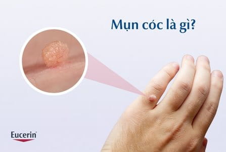 Mụn cóc là gì?