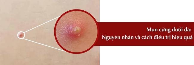 Mụn cứng dưới da do đâu, cách điều trị hiệu quả