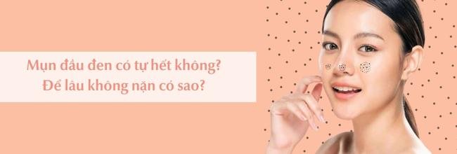 Mụn đầu đen có tự hết được không?