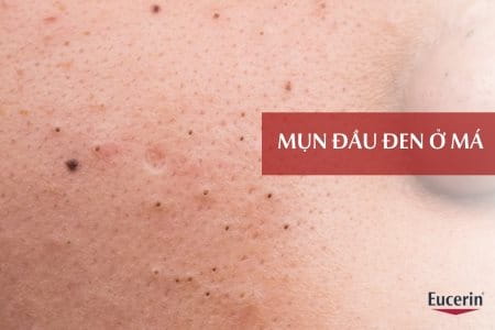 Mụn đầu đen ở má: Nguyên nhân, dấu hiệu và cách điều trị