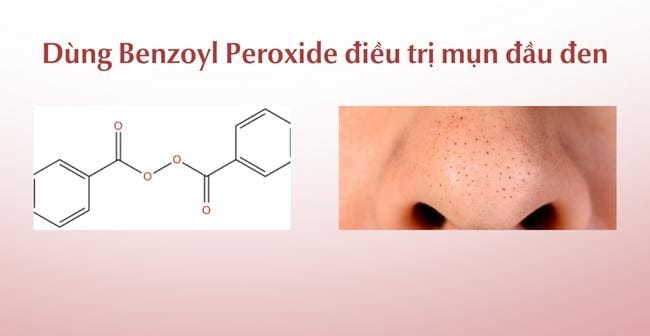 Trị mụn đầu đen hiệu quả với Benzoyl Peroxide