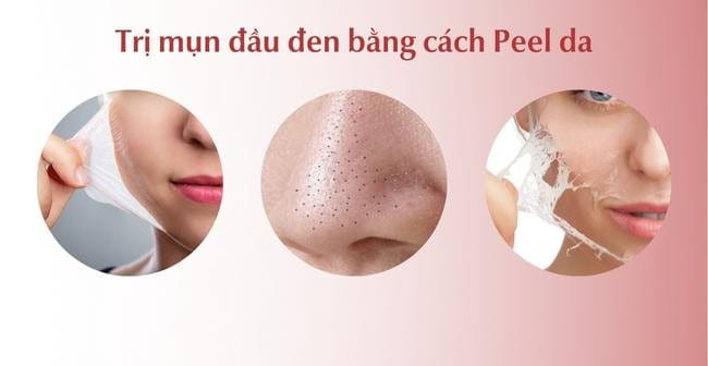 Peel da trị mụn đầu đen