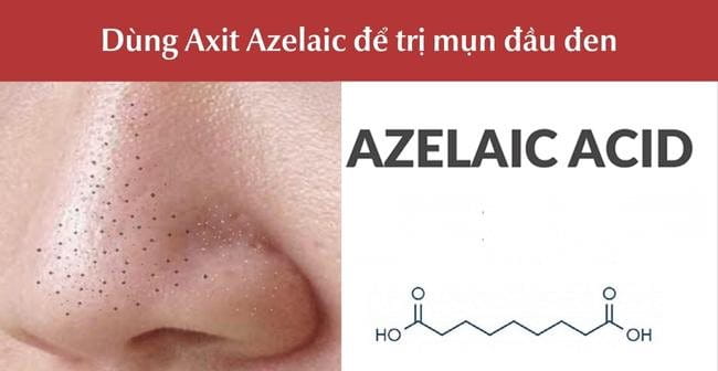 Trị mụn đầu đen ở mũi với Axit Azelaic