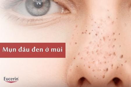 Nguyên nhân và cách trị mụn đầu đen ở mũi tận gốc, an toàn
