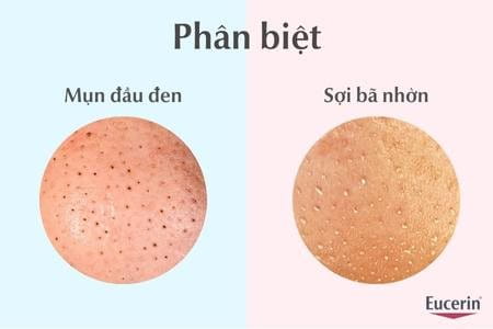 Phân biệt mụn đầu đen và sợi bã nhờn