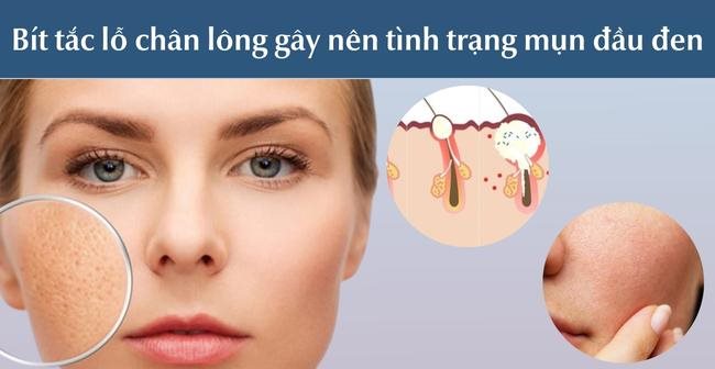 bít tắt lỗ chân lông gây mụn đầu đen