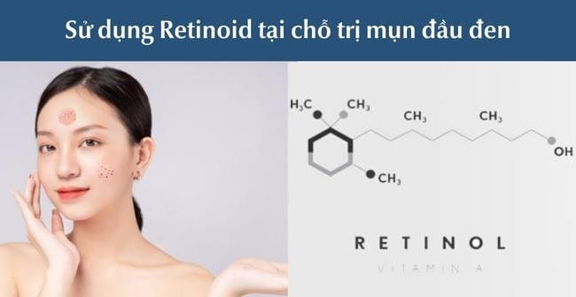 Sử dụng Retinoid tại chỗ trị mụn đầu đen