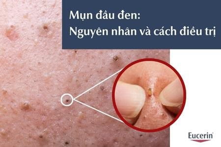 Mụn đầu đen nguyên nhân và cách điều trị