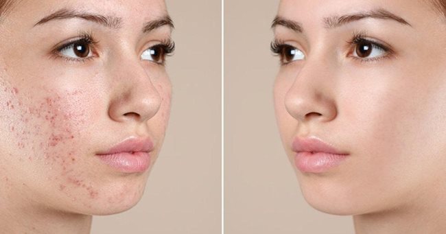 Da sạch mụn rạng rỡ cùng với công nghệ peel da trị mụn tiên tiến hiện nay