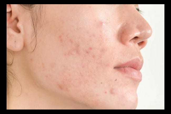 mụn dị ứng mỹ phẩm