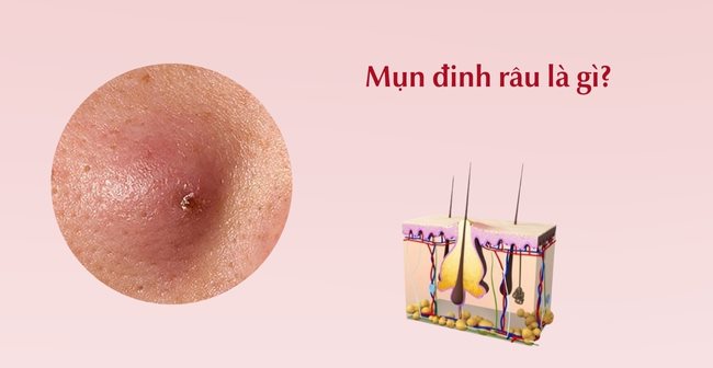 Mụn đinh râu là loại mụn gì?
