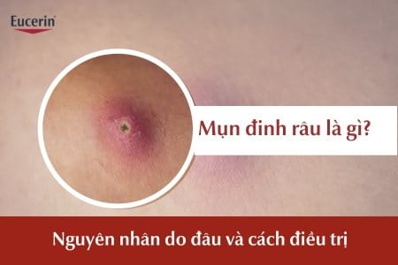 Mụn đinh râu là gì?