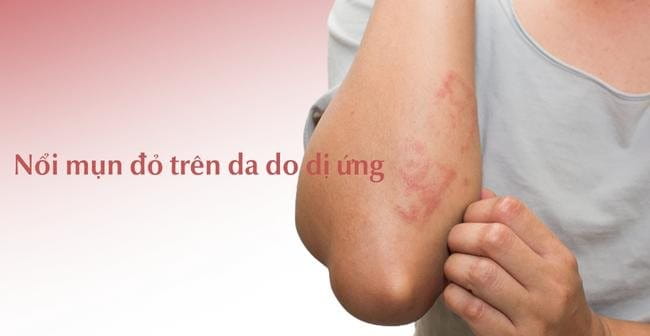 Dị ứng gây mụn đỏ trê n da