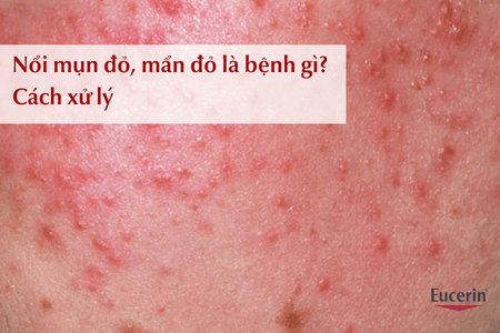 Mụn đỏ, mẫn đỏ là bệnh gì? Cách xử lý hiệu quả