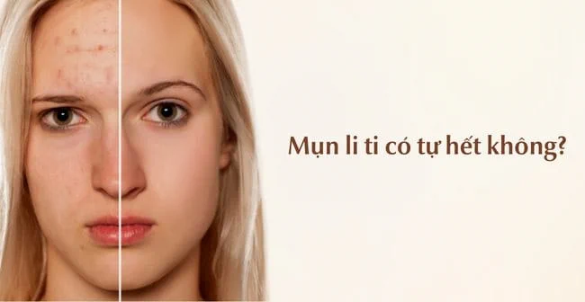 Mụn li ti có tự hết không?