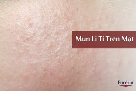 Mụn li ti trên mặt