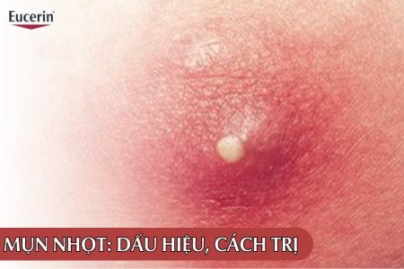 Mụn nhọt: Nguyên nhân, dấu hiệu và cách trị mụn nhọt hiệu quả