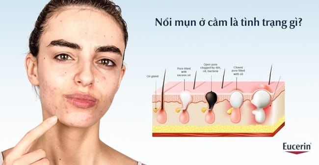 Nổi mụn ở cằm là gì?