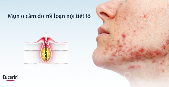 Mụn ở cằm do rối loạn nội tiết tố