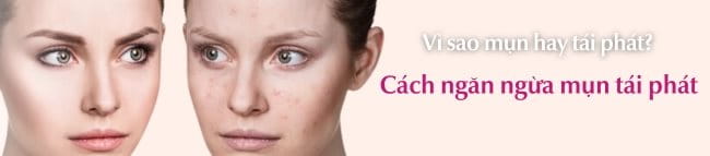 Cách ngăn ngừa mụn tái phát hiệu quả