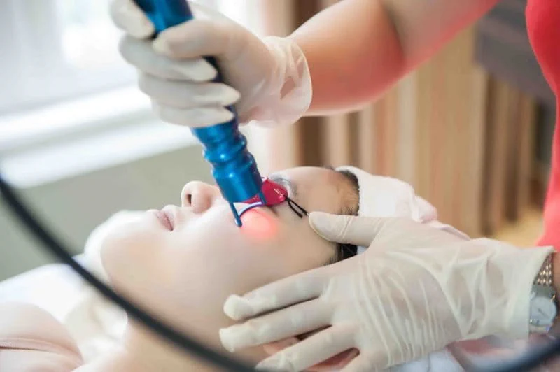 Trị mụn thịt bằng phương pháp laser