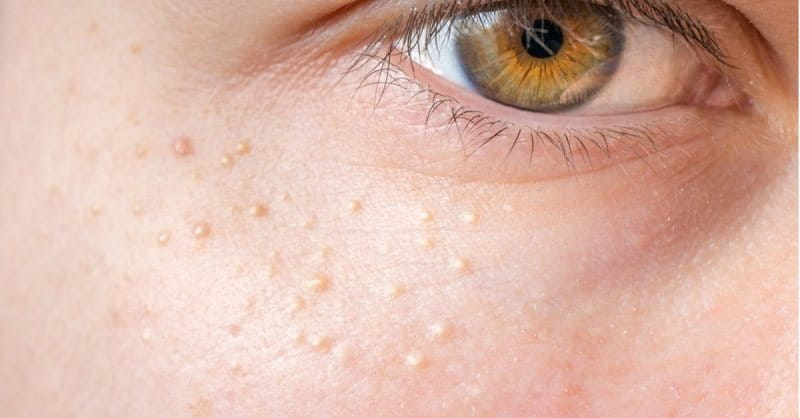 Mụn Thịt Là Gì? Nguyên nhân, Dấu Hiệu, Cách Trị Hiệu Quả