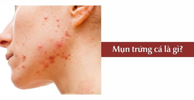 Mụn trứng cá là gì?